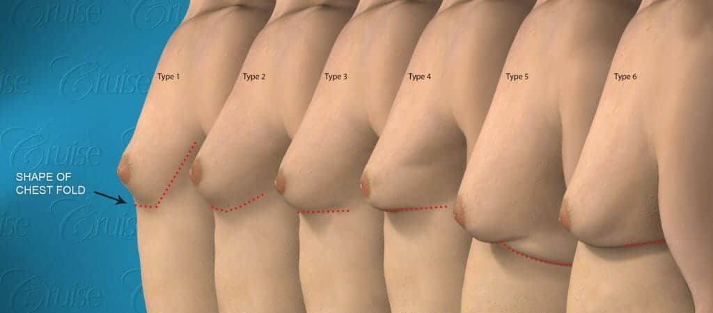 cruise-classification-6-types-gynecomastia