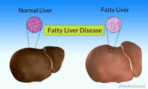 Fatty-Liver-Disease