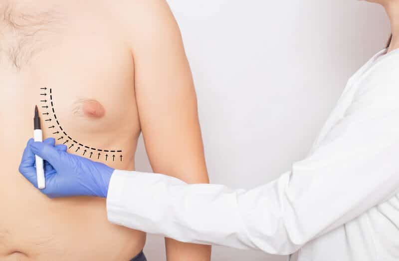 Can You Get Rid of Gyno Without Surgery?