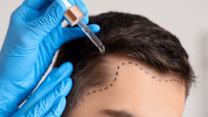 A high-angle close-up of a man’s receding hairline. The area is marked with a dotted black line (likely for a hair transplant), and a person in blue gloves is applying a serum with a dropper.
