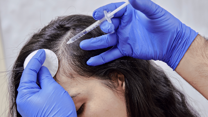 A close-up of a person receiving a scalp treatment. A practitioner wearing blue nitrile gloves uses a syringe to apply a clear liquid to the person's hair parting, while holding a cotton pad in the other hand.