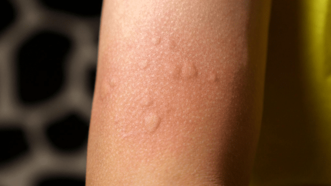 A close-up shot of a person's forearm showing several raised, red bumps on the skin.