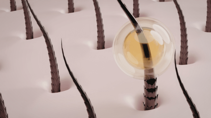 3D anatomical illustration of hair follicles on skin. One specific hair follicle is encased in a transparent, golden, bubble-like sphere, representing a protective treatment or nutrient delivery to the root.