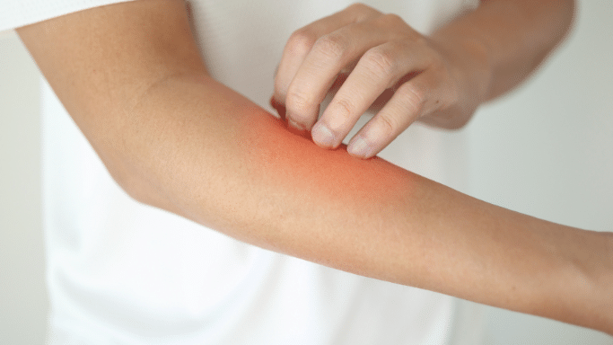 A close-up of a person's forearm showing a large, inflamed red patch of skin. Their other hand is actively scratching the irritated area.