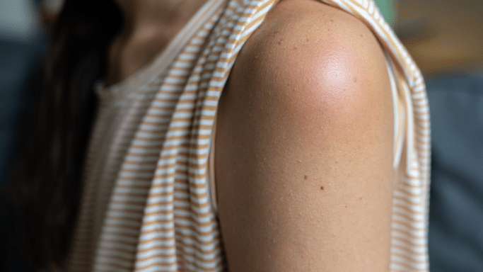 A close-up of a person's shoulder showing a large, red, and swollen area, likely a skin reaction or inflammation, against a tan and white striped shirt.