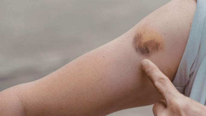 A close-up of a person's upper arm showing a large, circular bruise. The bruise transitions in color from a dark purple and maroon center to a yellowish-brown edge. A finger points toward the center of the injury for scale or emphasis.