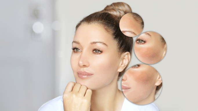 A portrait of a woman resting her chin on her hand, looking into the distance. To her right, three floating circular inset graphics zoom into specific areas of skin, showcasing patches of uneven skin tone and brown hyperpigmentation (melasma) on the forehead and cheek.