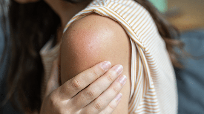 close-up view focusing on a woman's shoulder. Her skin exhibits a distinct, raised, circular red patch that indicates inflammation, an allergic reaction, or a post-injection swelling response. She has her hand placed just below the area.