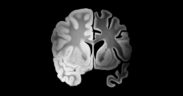 A black-and-white coronal cross-section of a human brain MRI scan, detailing the symmetry of the cerebral hemispheres and inner ventricles against a dark background.