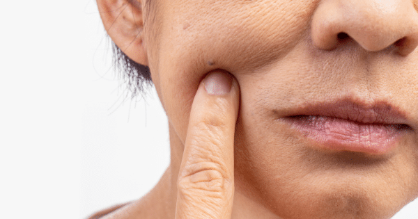 Close-up of a person pushing upwards on their cheek skin near their mouth with an index finger.