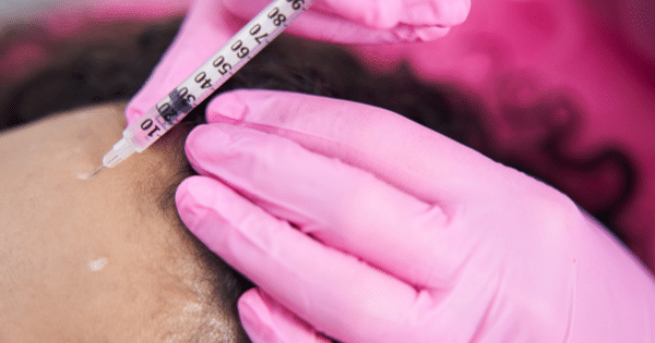 Close-up of a medical professional wearing pink gloves using a syringe near a patient's hairline.