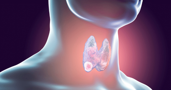A 3D medical graphic depicting a translucent silhouette of a human neck and chin, featuring a glowing butterfly-shaped thyroid gland with a small highlighted nodule on its lower right lobe.