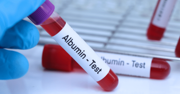 Gloved hand holding a blood collection tube labeled "Albumin - Test" next to other test tubes on a rack.