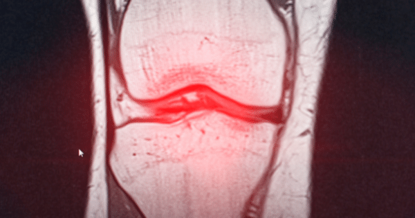 MRI scan of a knee joint featuring a red highlighted area across the cartilage gap.
