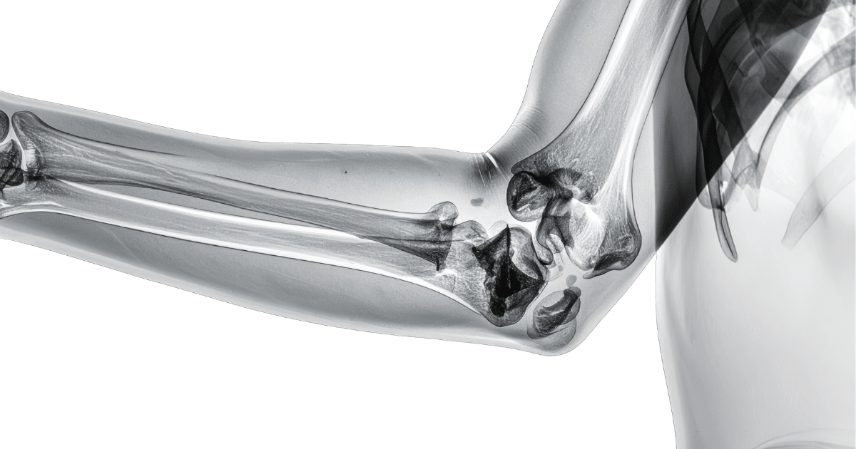 An X-ray rendering of a human arm bent at the elbow, displaying the bones of the forearm, upper arm, and joint structure.